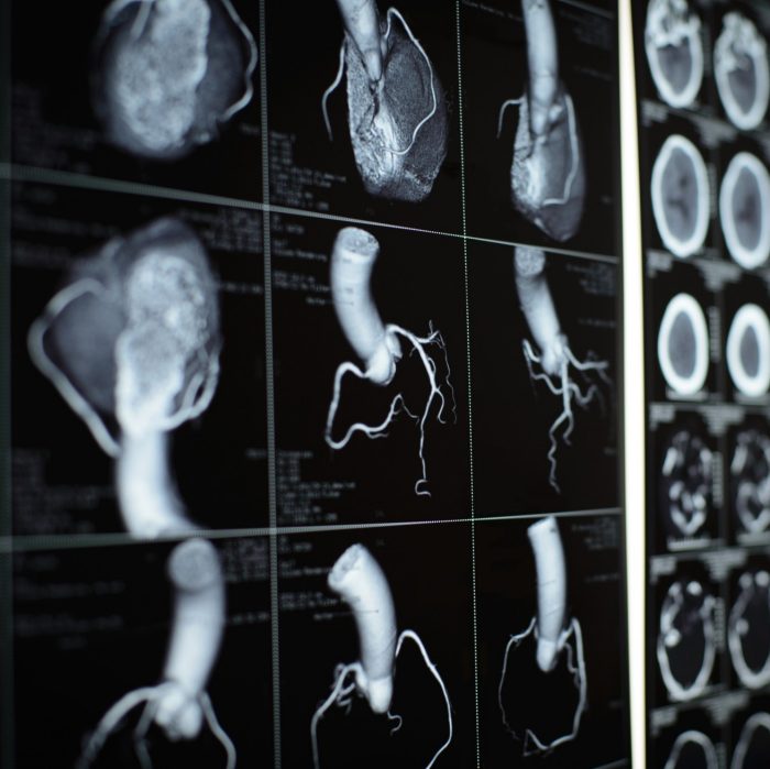 Coronary artery CT images on black film of human heart and coronary artery